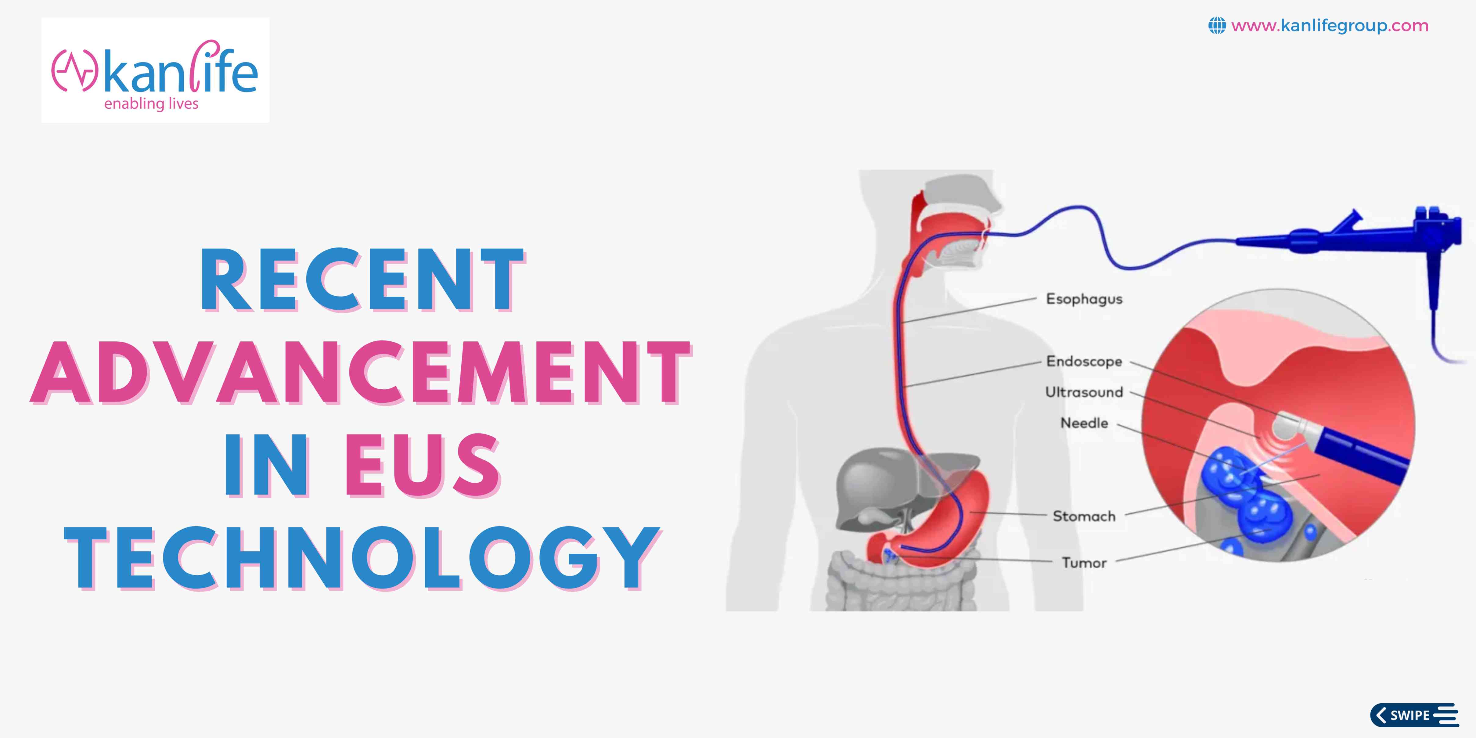 Recent Advancements in Endoscopic Ultrasound (EUS) Needle Technology: What's New?